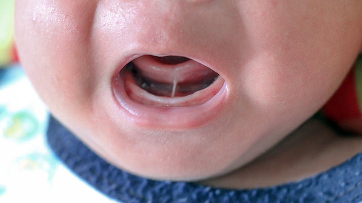 Photo showing a tongue tie in a small child